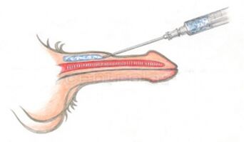 Обемно инжектиране на хиалуронова киселина в пениса
